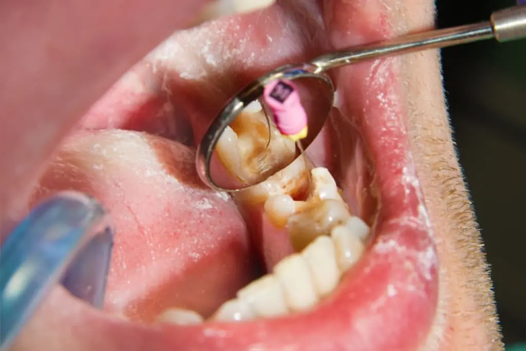 Endodoncia en Granada
